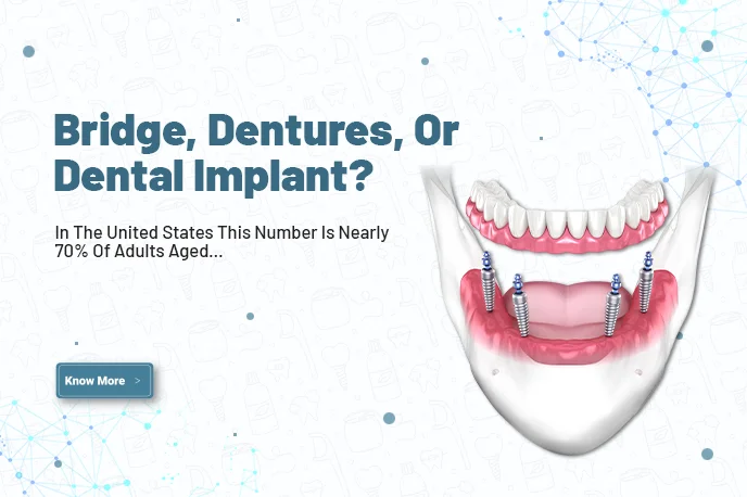 Bridge, dentures, or dental implant?