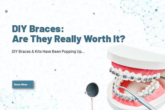 DIY braces: Are they really worth it?