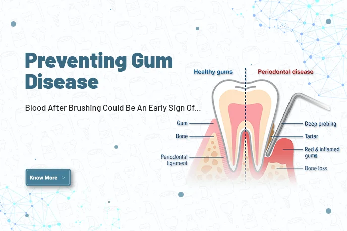 Preventing gum disease